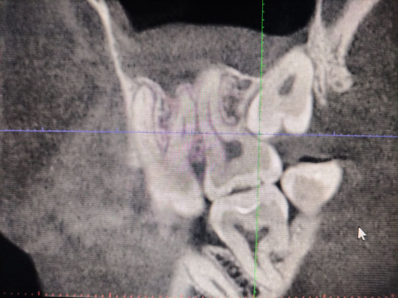 Удаление зуба мудрости - ДИМЕДА